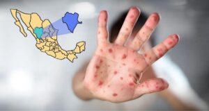 Reportan 185 casos de sarampión en Durango; activan jornada de vacunación en La Laguna